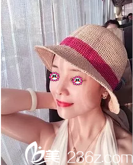 北京米揚(yáng)麗格巫文云自體軟骨鼻綜合隆鼻案例