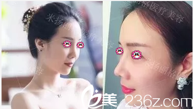 北京米揚(yáng)麗格找巫文云做隆鼻前后對比效果