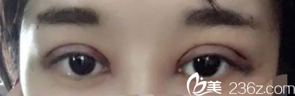 全切雙眼皮天 全切雙眼皮天