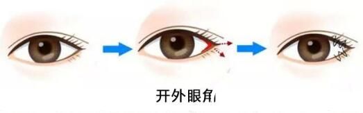 開眼角的原理