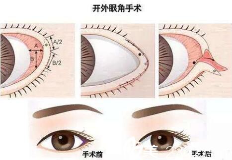 如何避免開眼角的危害