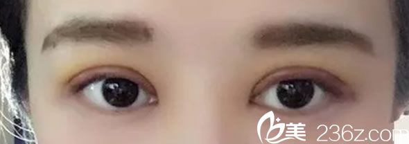 割雙眼皮第三天恢復(fù)效果 割雙眼皮第三天恢復(fù)效果