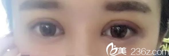 全切雙眼皮第7天恢復(fù)效果圖 全切雙眼皮第7天恢復(fù)效果圖