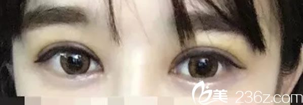 單眼皮妹子在韓國(guó)娜娜整形醫(yī)院找崔相録醫(yī)生做切開法雙眼皮后靈動(dòng)有神