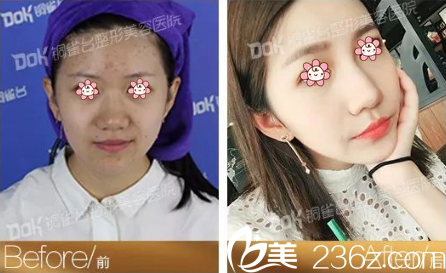 怎樣祛痘才有效？分享重慶銅雀臺痘痘粉刺困擾者小饒的祛痘凈白過程。