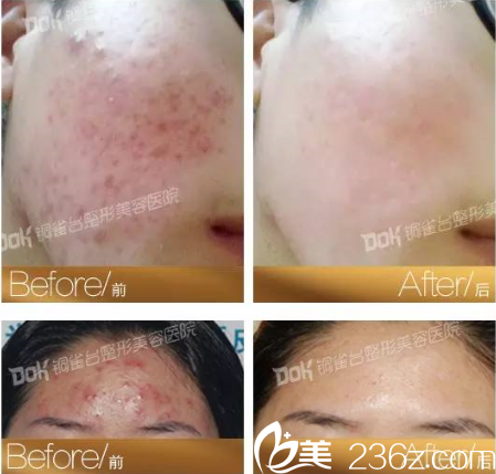 重慶銅雀臺(tái)祛痘怎么樣