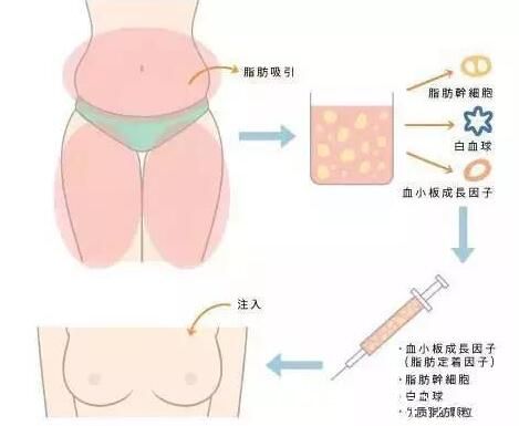 韓國(guó)Cara整形外科金賢秀自體脂肪隆胸原理 韓國(guó)Cara整形外科金賢秀自體脂肪隆胸原理