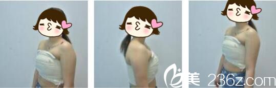 韓國Cara整形外科金賢假體隆胸真人案例術(shù)后第三天