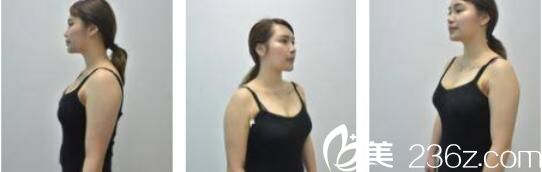 韓國Cara整形外科金賢假體隆胸真人案例術(shù)后十五天