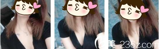 韓國Cara整形外科金賢假體隆胸真人案例術(shù)后二十一天