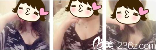 胸下垂的我去韓國(guó)Cara找金賢秀做假體隆胸，讓胸部重新二次發(fā)育起來(lái)