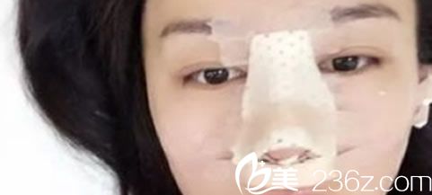 隆鼻手術(shù)第2天