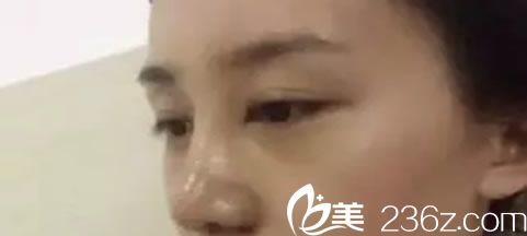 鼻子做完假體9天恢復(fù)圖