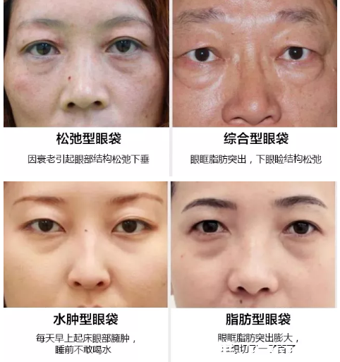 常見的幾種眼袋情況