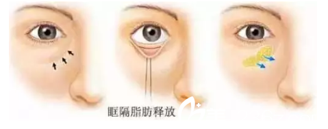 眼底眶隔脂肪重置