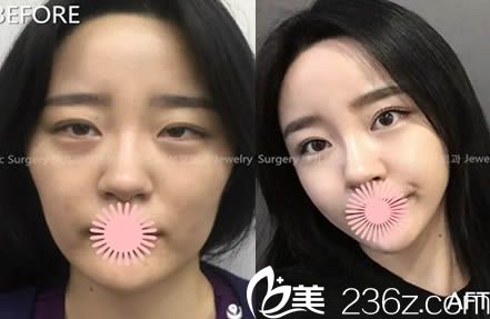 韓國(guó)珠兒麗面部脂肪移植效果對(duì)比圖