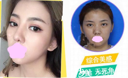 壹美尚李東霖蒙特鼻鼻綜合整形案例 壹美尚李東霖蒙特鼻鼻綜合整形案例