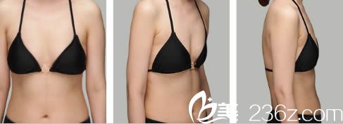 韓國愛我整形醫(yī)院假體隆胸術前照 韓國愛我整形醫(yī)院假體隆胸術前照