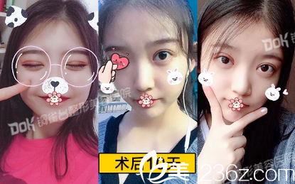 術(shù)后10天效果