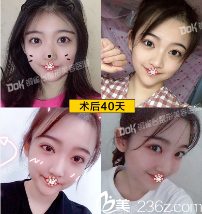 重慶銅雀臺(tái)<!--<i data=20240703-sp></i>-->做雙眼皮效果怎么樣