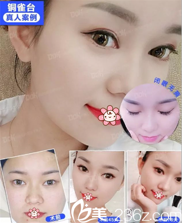 重慶銅雀臺(tái)韓式切開(kāi)雙眼皮真實(shí)案例效果對(duì)比