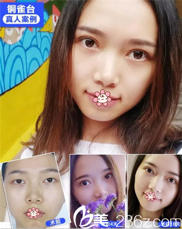 重慶銅雀臺(tái)做雙眼皮效果好不好