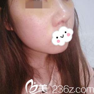 自體軟骨隆鼻第8天