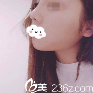 隆鼻半個月后的效果