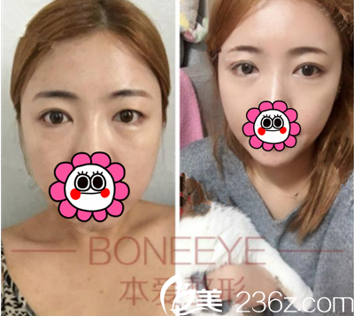 文圣昊院長雙重線無痕雙眼皮案例 文圣昊院長雙重線無痕雙眼皮案例