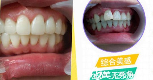 秦洪章牙齒半隱形矯正案例 秦洪章牙齒半隱形矯正案例