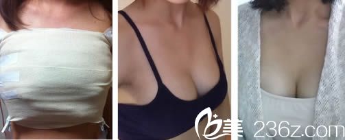 韓國愛我整形樸范鎮(zhèn)院長給做假體隆胸的當天照和術后兩個月照 韓國愛我整形樸范鎮(zhèn)院長給做假體隆胸的當天照和術后兩個月照