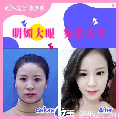 東莞壹加壹王擎做的雙眼皮案例