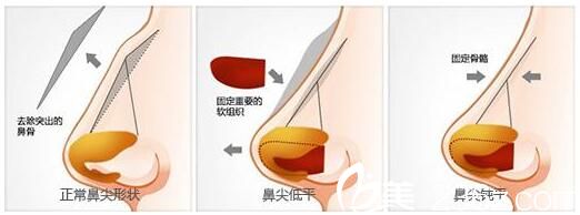 韓國(guó)AURORA整形外科醫(yī)院李志永鷹鉤鼻矯正 韓國(guó)AURORA整形外科醫(yī)院李志永鷹鉤鼻矯正