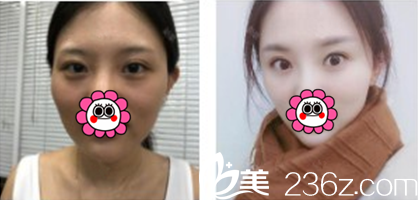 玻尿酸墊下巴案例對比圖