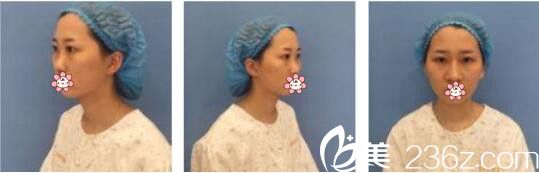 韓國AURORA整形外科醫(yī)院李志永鼻綜合真人案例術(shù)前照 韓國AURORA整形外科醫(yī)院李志永鼻綜合真人案例術(shù)前照