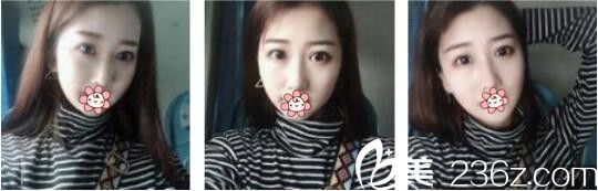 韓國AURORA整形外科醫(yī)院李志永鼻綜合真人案例術(shù)后一個月 韓國AURORA整形外科醫(yī)院李志永鼻綜合真人案例術(shù)后一個月