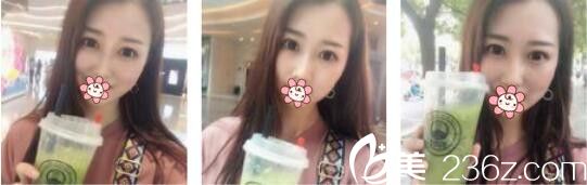 訴說我去韓國AURORA找李志永做鼻綜合三個(gè)月的恢復(fù)心里路程