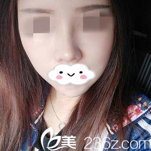 鼻修復(fù)術(shù)后半個(gè)月 鼻修復(fù)術(shù)后半個(gè)月