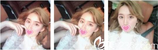 韓國奧拉克皮膚科整外科李正馥面部提升真人案例術(shù)后第七天