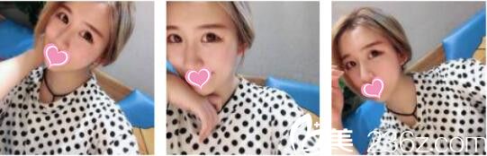 韓國奧拉克皮膚科整外科李正馥面部提升真人案例術(shù)后一個月