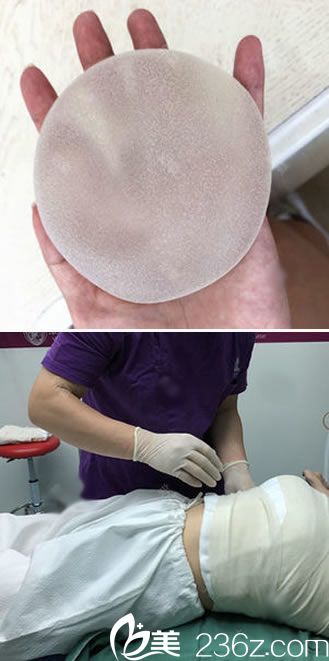 做隆胸假體和剛做完的照片