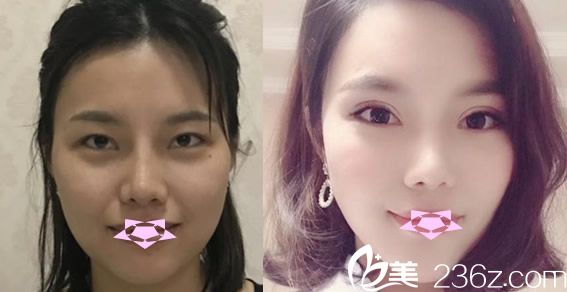 合肥壹美尚雙眼皮失敗修復(fù)案例