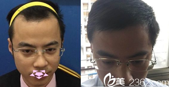 方蜜發(fā)際線種植案例