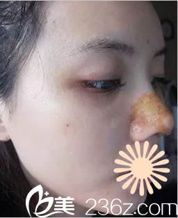 韓國(guó)枓翰整形鼻綜合術(shù)后5天照