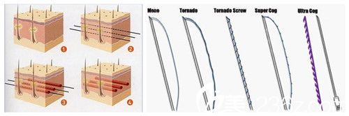 埋線提升使用的細(xì)線
