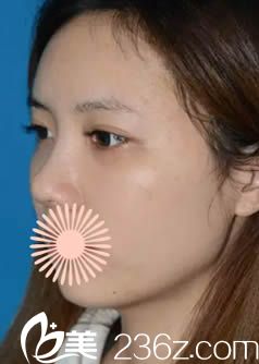 韓國(guó)申?yáng)捄册t(yī)生做面部脂肪填充和鼻綜合術(shù)后15天照