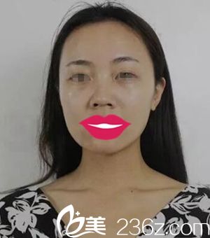 駐馬店美蘭德做鼻綜合手術(shù)前 駐馬店美蘭德做鼻綜合手術(shù)前