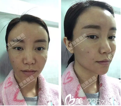 自體脂肪面部填充術(shù)后3天