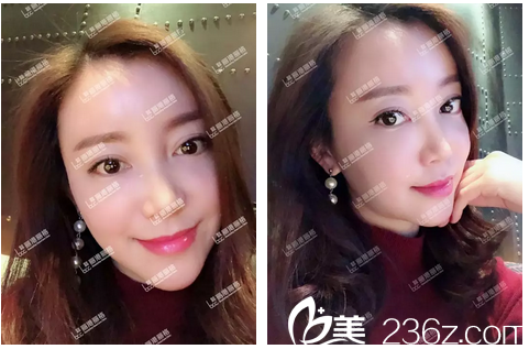 自體脂肪填充全臉術(shù)后一個月