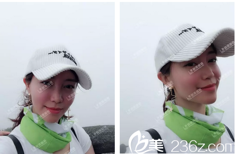 做完自體脂肪填充全臉術(shù)后兩個月